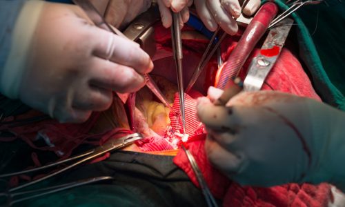 kipcor-tratamento-cirurgia-aorta-aberta